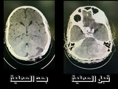 مجمع الملك عبدالله الطبي بجدة ينقذ حياة ثلاثيني بعد تعرضه لشبه غيبوبة