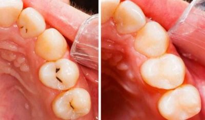 التخلص من تسوس الأسنان دون زيارة الطبيب