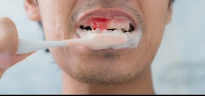 التهاب الاسنان واللثة