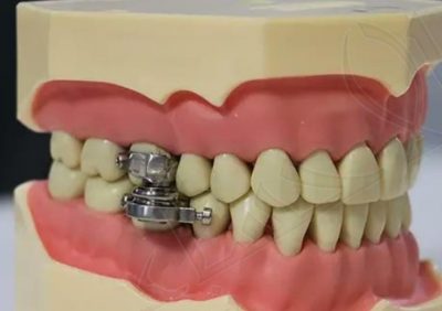 قفل للأسنان جهاز جديد لإنقاض الوزن