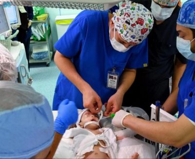 نجاح عملية فصل التوأم الطفيلي اليمني في الرياض