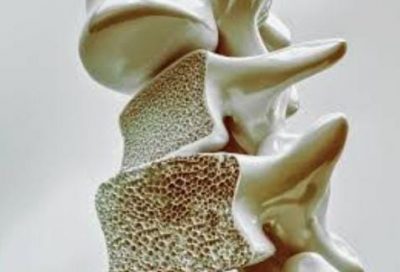 تخلخل العظـام OSTEOPOROSIS