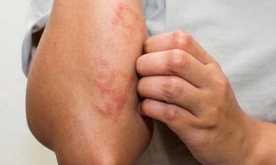 9 أطعمة ينبغي لمرضى الإكزيما تجنبها