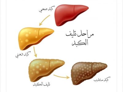 اعراض تليف الكبد ودرجات تطوره وطرق علاجه..