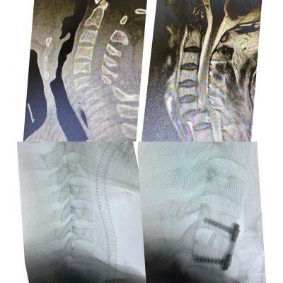 مستشفى الملك فهد بجدة ينجح في إنقاذ مريض من الإصابة بشلل دائم..