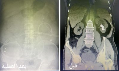 أكثر من ساعتين لإزالة حصوات كلوية لمريض بجدة…