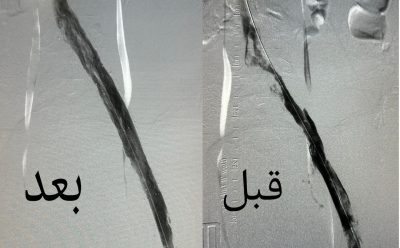 فريق طبي يعالج مريضاً من متلازمة ضغط الوريد الحرقفي