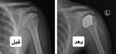سعود الطبية تُجري أول عملية لتبديل رأس عظمة العضد في مفصل الكتف..