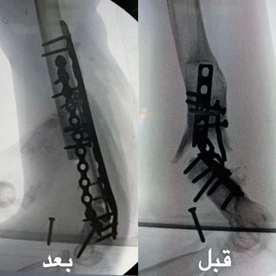 “سعود الطبية” تعيد الحركة لمفصل كوع مريض بعد 10 أعوام من العجز..